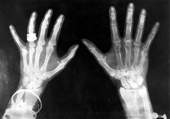 X-rays of the hands of King George and Queen Mary, 1896.