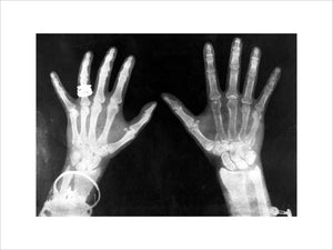 X-rays of the hands of King George and Queen Mary, 1896.